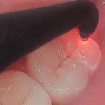 Diagnodent laser