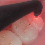 Diagnodent laser